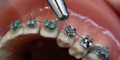 أنواع تقويم الأسنان بالصور واسعارها – زيادة